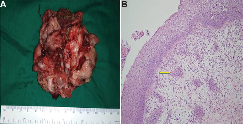 (A) Excised mass in piece meal. (B) Histopathological examination showing respiratory epithelium lining with multiple, thin-walled dilated vessels in a pool of eosinophilic granulomas suggestive of angiomatous polyp, which is represented by yellow arrow.